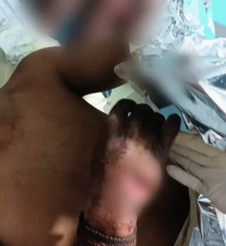 Rapaz de 22 anos tem dedos decepados durante briga de facão em festa – CREDITO: CAMPO GRANDE NEWS