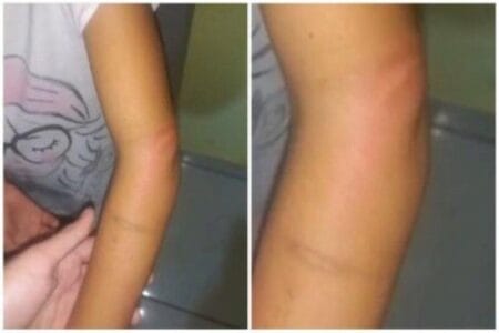 Mãe bate na filha de 5 anos com pedaço de madeira e quebra o braço da criança