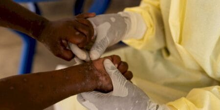 Casos de mpox no Brasil este ano já superam o total de 2023