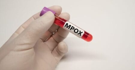 Corumbá confirma primeiro caso de mpox