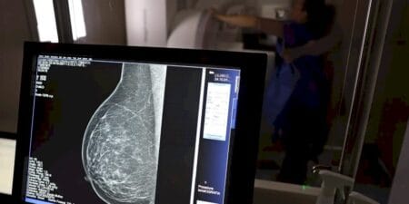 Periodicidade de mamografias divide médicos e autoridades de saúde