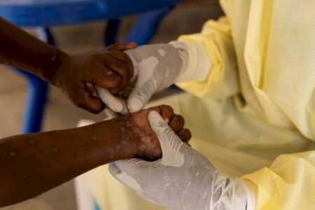 O que se sabe sobre a nova variante de Mpox identificada no Brasil