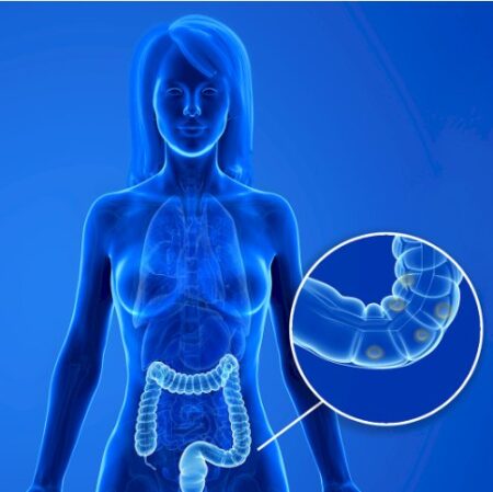 Dieta para diverticulite: o que comer e o que não comer?