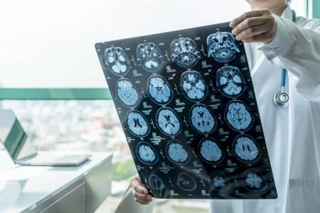 Entenda as promessas do medicamento recém-aprovado para câncer cerebral
