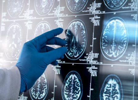 Inflamação no cérebro pode ser peça-chave na progressão do Alzheimer