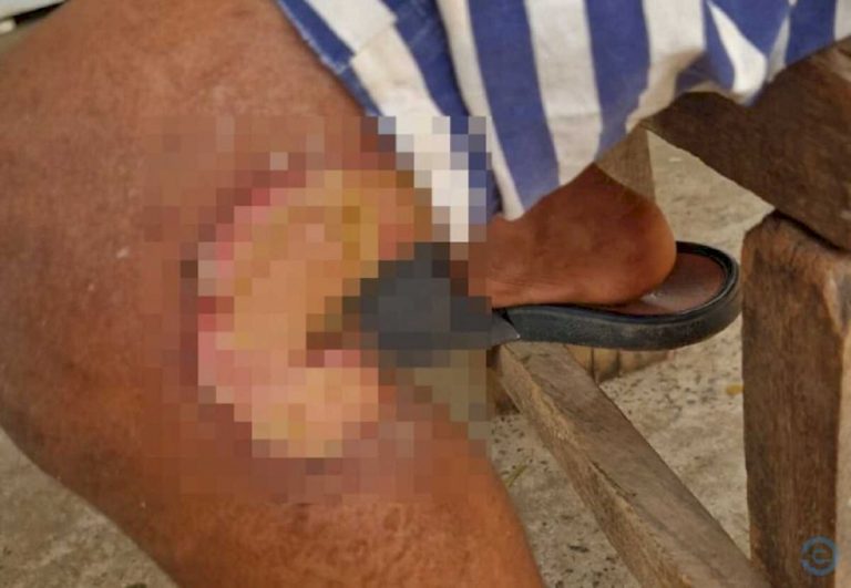 Criança é internada com queimaduras e mãe é suspeita de maus-tratos