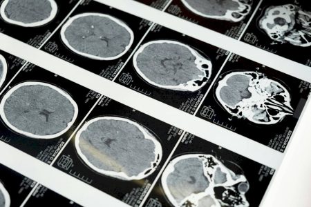 Exame em estudo pode antecipar diagnóstico da esclerose múltipla em 7 anos