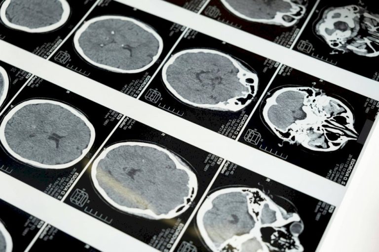 Exame em estudo pode antecipar diagnóstico da esclerose múltipla em 7 anos