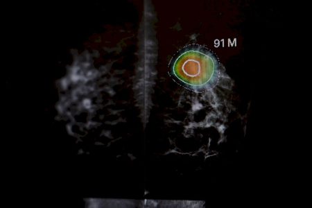 Mamografia com IA melhora diagnóstico de câncer, mostra estudo