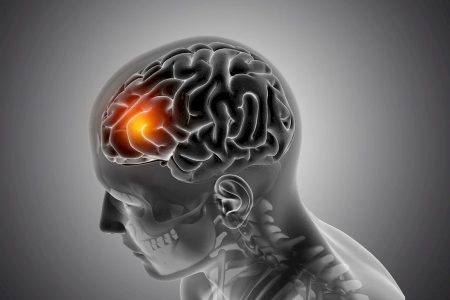 Neurologista revela sinais ‘silenciosos’ do AVC que muita gente ignora