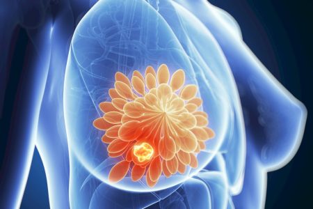 Estudo aponta impactos da dieta, exercícios e vitamina D em pacientes com câncer de mama