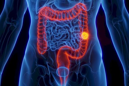 O efeito das canetas emagrecedoras no risco de câncer de intestino