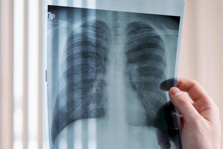 Pacientes com câncer de pulmão vivem menos no SUS, mostra estudo